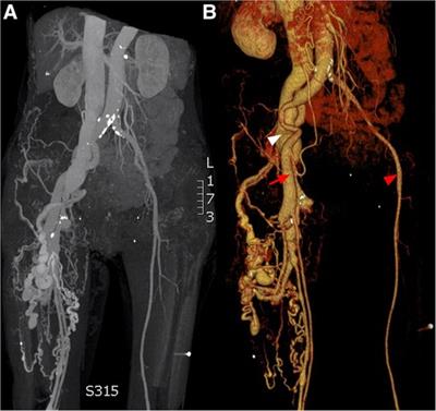 Case Report: Transcatheter closure of a giant post-traumatic femoral arteriovenous fistula using ventricular septal occluder